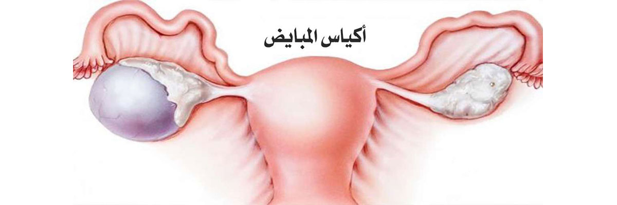 يظهر كيف نسر  أكياس المبايض | د.هلال ابوغوش | افضل دكتور جراحة نسائية في الاردن